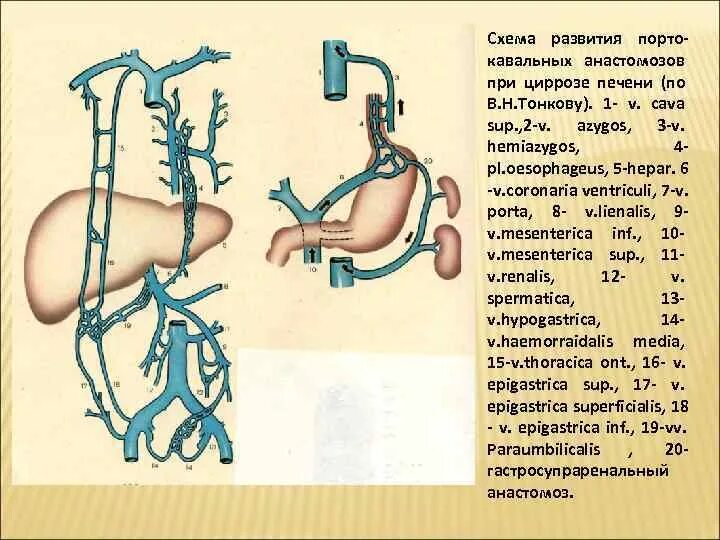 Значение кава кавальных анастомозов. Кава кава портальные анастомозы. порто-кава-кавальный анастомоз схема. портокавальные анастомозы пищевода. кава кавальные и портокавальные анастомозы таблица.