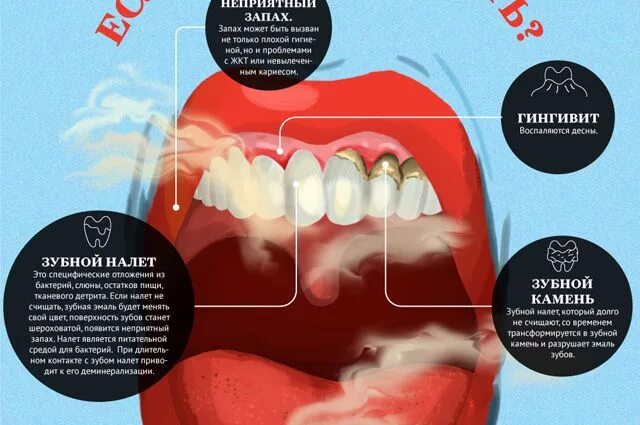 Плохая гигиена рта. Зубы инфографика. Плохая гигиена полости рта.