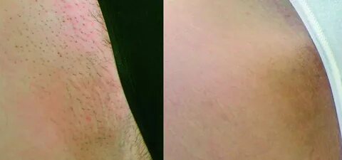 Видео депиляции интимных местах