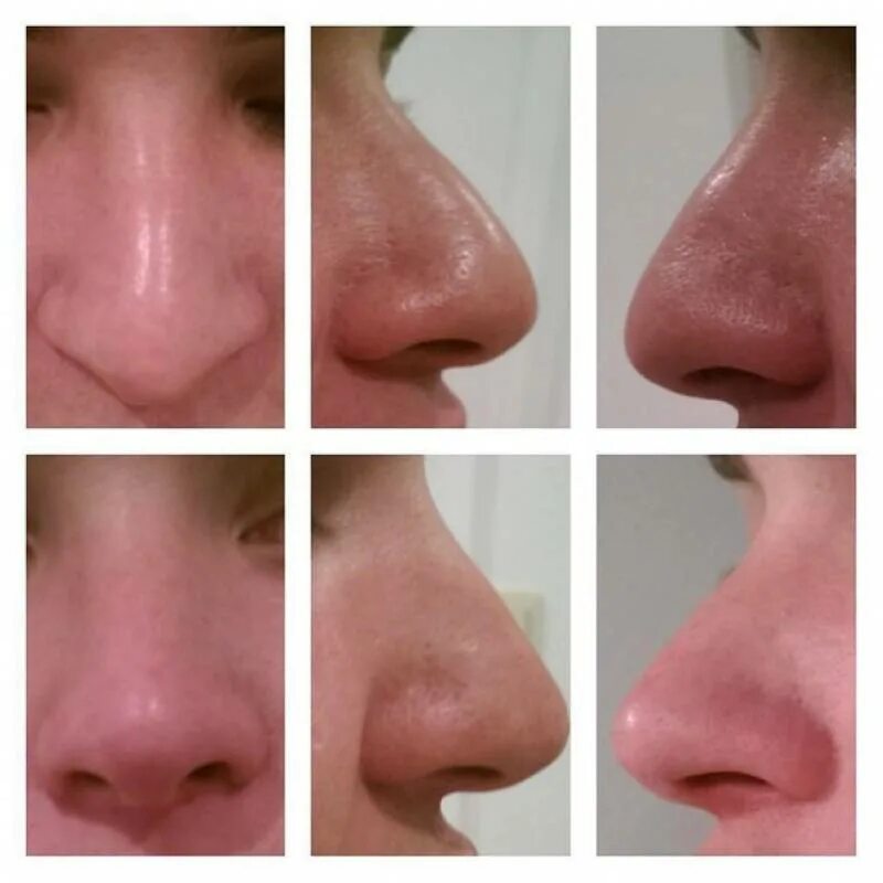 нос крылья носа переносица