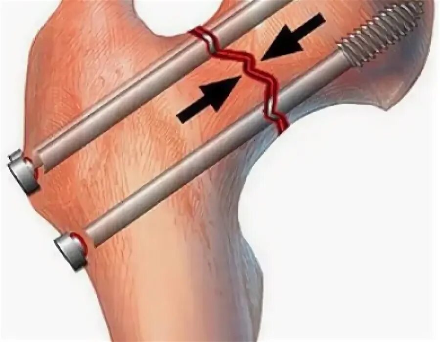 Перелом шейки бедра остеосинтез. Шейка бедра перелом остеосинтез. Остеосинтез шейки бедра винтами. Остеосинтез винтами при переломе шейки бедра.