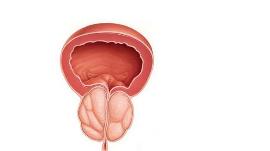 Простатит вектор. Простатит и аденома простаты вектор. Небактериальный простатит
