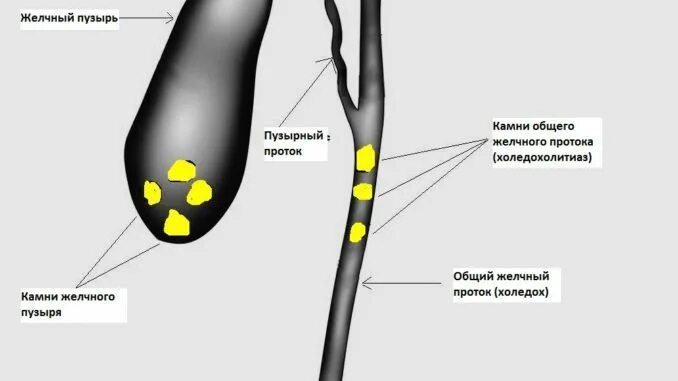 Очистка желчного пузыря. Камень в протоке желчного пузыря. Конкремент общего желчного протока.