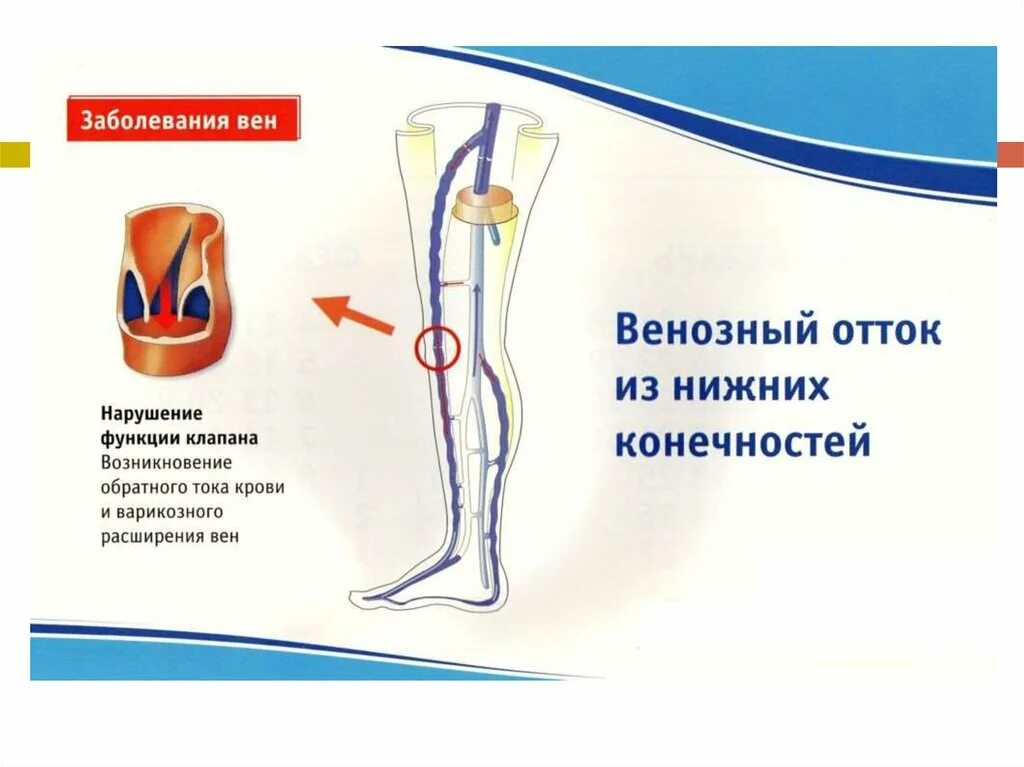 Клапаны в венах нижних конечностей. Клапаны в венах нижних конечностей. Венозные клапаны варикоз. Клапаны в венах нижних конечностей. Строение клапанов вен.