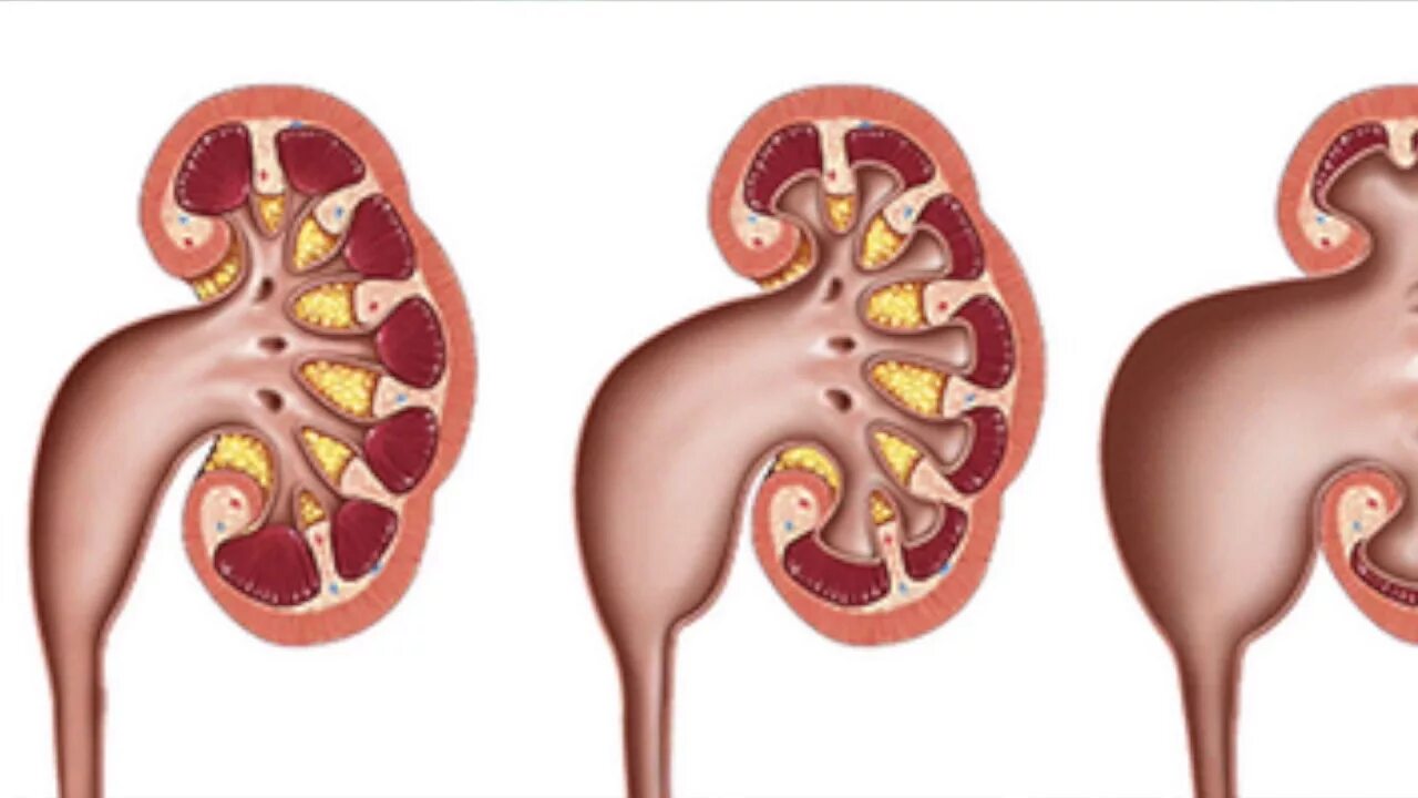 Заболевание почек гидронефроз. Гидронефроз почки 3 степени. Гидронефроз левой почки 2ст. Гидронефроз почки 3 стадии.