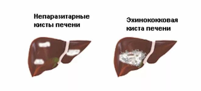 После удаления кисты печени. Эхинококкоз поражение печени. Эхинококк киста печени. Печень пораженная эхинококкозом. Однокамерный эхинококк печени.