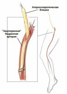 Ноги после шунтирования