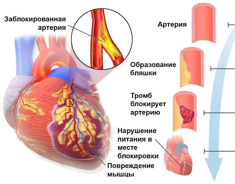 Причины развития острого инфаркта миокарда. Острый период инфаркта миокарда клиника. Бляшки инфаркт миокарда. Сердце при инфаркте миокарда.