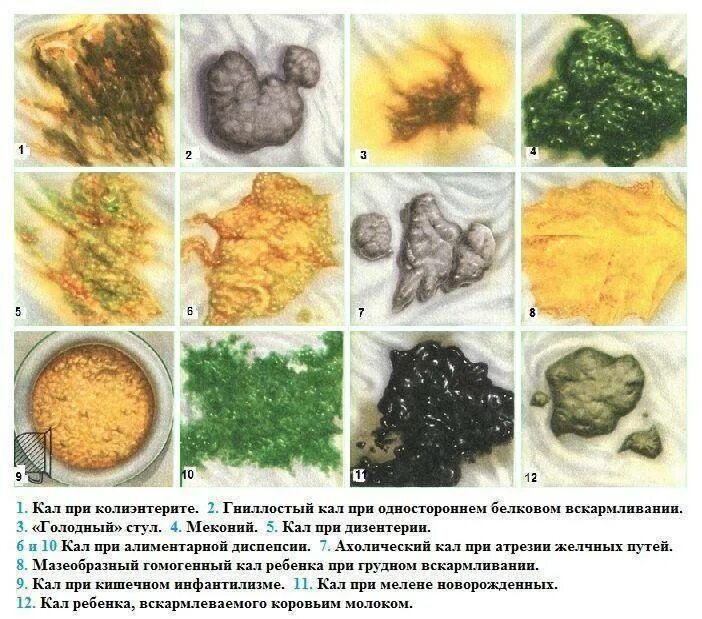 Изменился цвет кала. Норма кала на грудном вскармливании. Калл у грудничка в 3 месяца на грудном вскармливании. Нормальный стул у грудничка на грудном вскармливании.