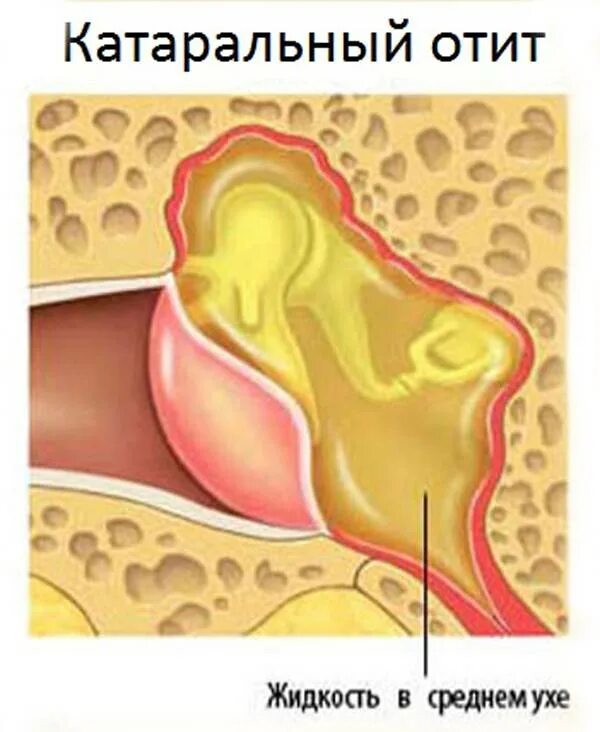 Гнойный отит барабанная перепонка. Острый Гнойный средний отит барабанная перепонка. Хронический туботимпанальный Гнойный средний отит. Стадии среднего гнойного отита