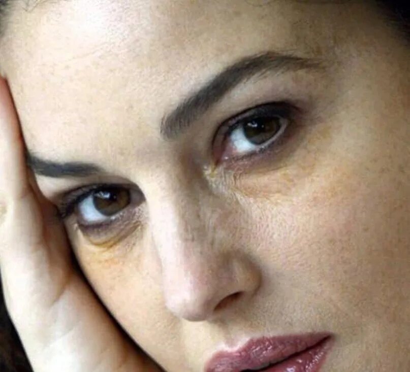 Желтые круги вокруг глаз. Желтая кожа вокруг глаз. Желтые синяки под глазами. Желтая кожа вокруг глаз. Слегка желтоватые глаза.