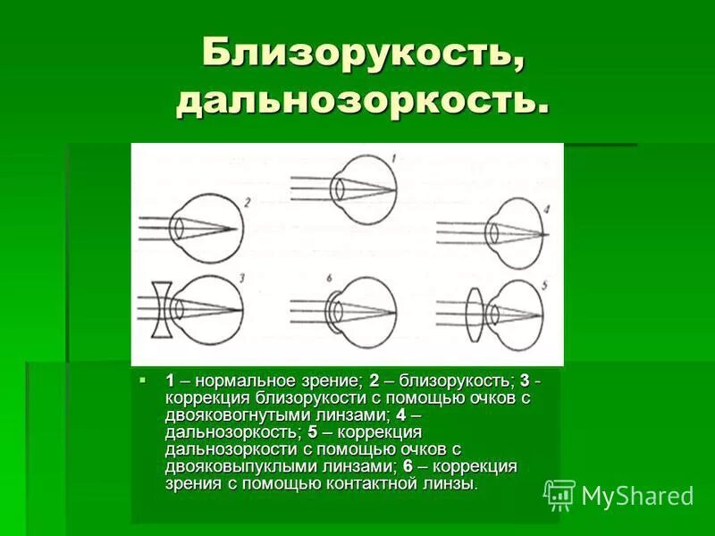 Линзы для зрения дальнозоркость. Для коррекции близорукости используются линзы двояковыпуклые. Коррекция близорукости и дальнозоркости с помощью очков. Коррекция зрения с помощью двояковыпуклой линзы. Двояковыпуклая линза для дальнозоркости.