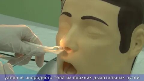 Как удаляют инородные тела попавшие в нос