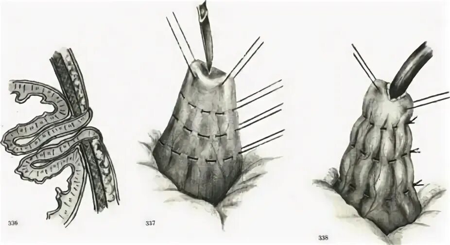 гастростомия по г. виды гастростом по кадеру техника наложения. гастростома по топроверу. гастростомия топографическая анатомия. гастростомия протокол операции по топроверу.