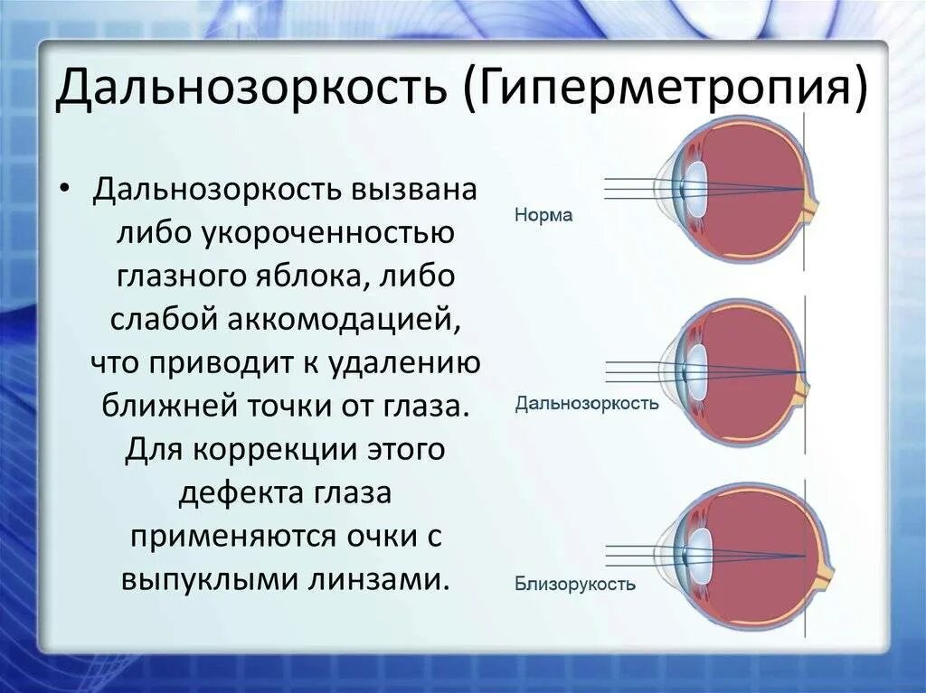 Дальнозоркость что делать. Гиперметропия 2 степени глаз. Гиперметропия слабой степени. Гиперметропия высокой степени. Дальнозоркость высокой степени.