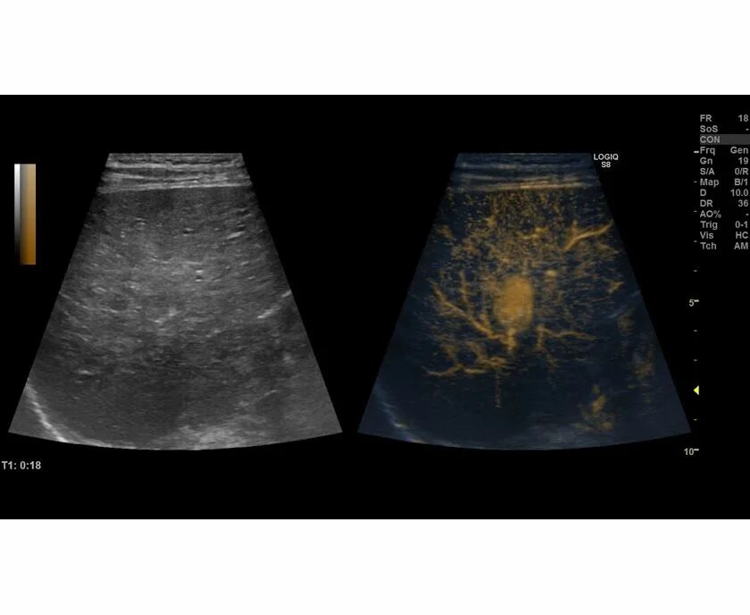 УЗИ С эхоконтрастирование с контрастных препаратов. УЗИ печени контрастирование. Эхоконтарстирование при УЗИ. Ультразвуковые контрастные вещества. Слабительные узи