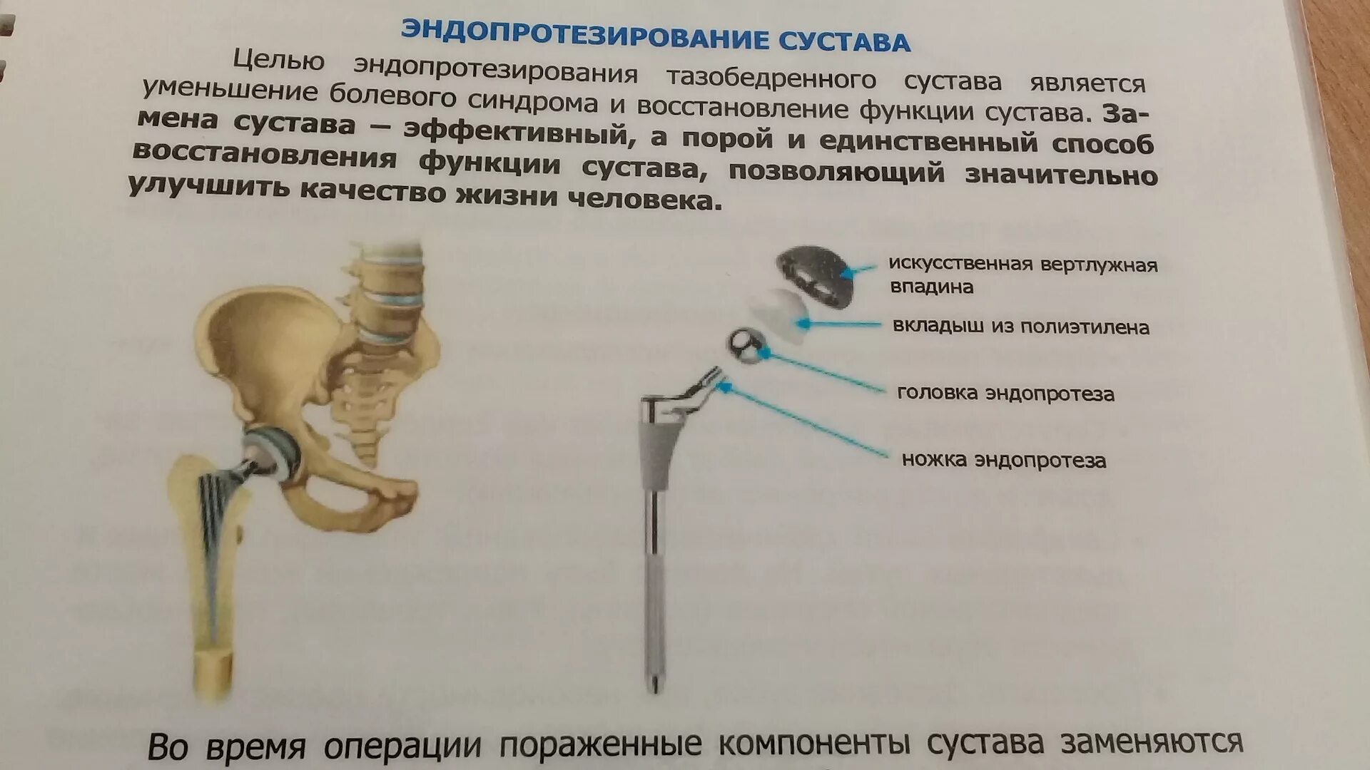 Эндопротез тазобедренный Stryker v40tm. Эндопротез тазобедренного сустава устройство. Эндопротез тазобедренного и коленного сустава. Операция эндопротезирование шейки бедра.