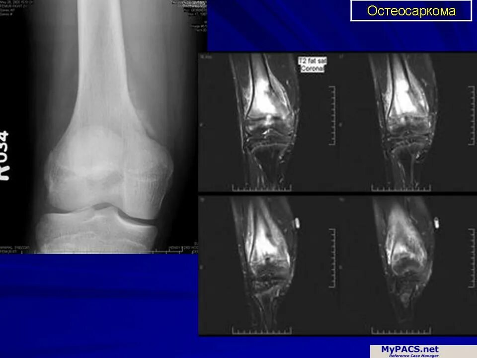 Рак в костях прогноз. Остеосаркома коленного сустава рентген. Остеосаркома рентген признаки.