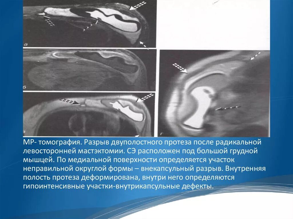 Имплант и мрт можно ли. Импланты на УЗИ протокол. Импланты молочной железы протокол УЗИ. Протокол УЗИ С имплантами молочных. Импланты молочных желез на УЗИ.