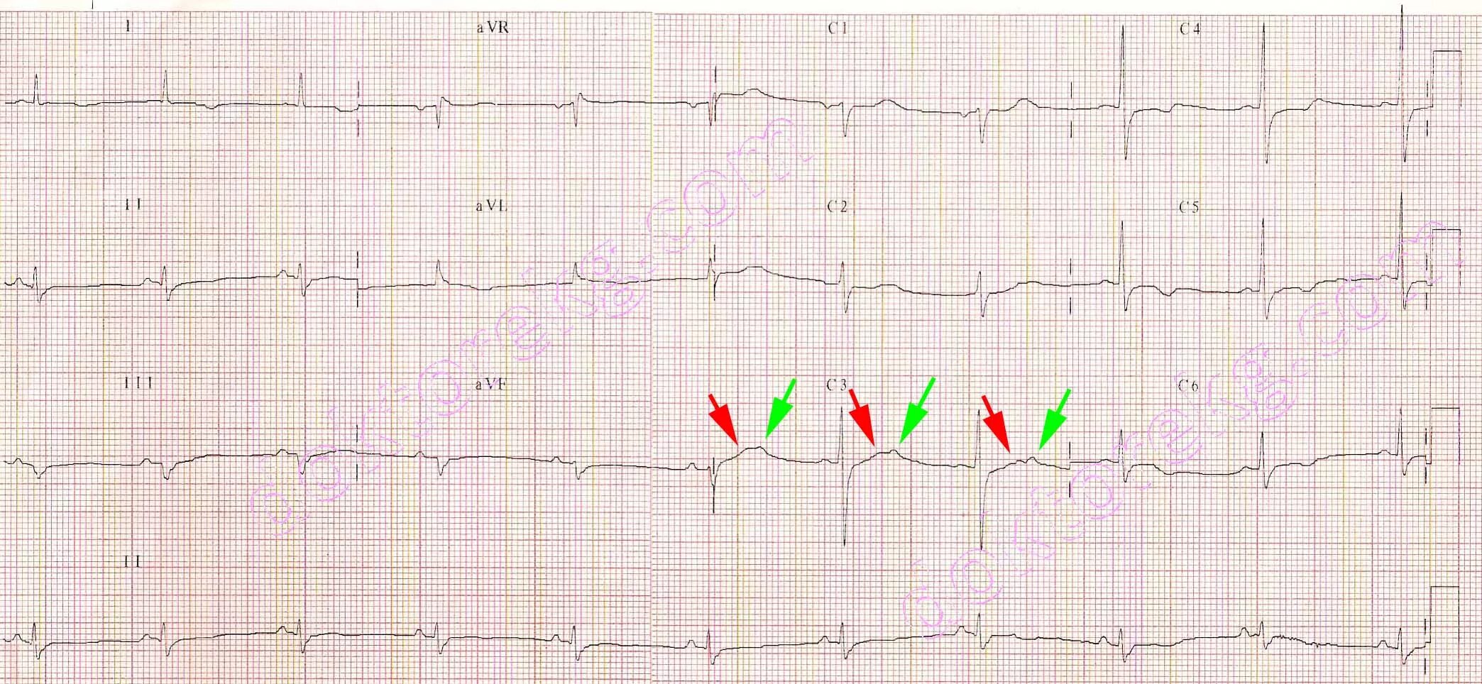 зубец u на экг отражает. экг у ребенка при синусовой аритмии. зубец u на экг. экг сердца при неполной блокаде правой ножки пучка гиса.
