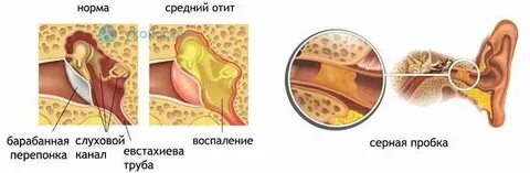 Сколько дней отит у взрослых