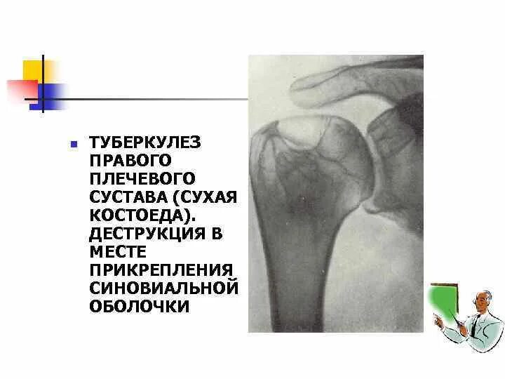 Туберкулез суставов симптомы. Рентген симптомы туберкулёза суставов. костный туберкулез плечевой кости. туберкулез головки плечевой кости рентген. туберкулез плечевого сустава рентген.
