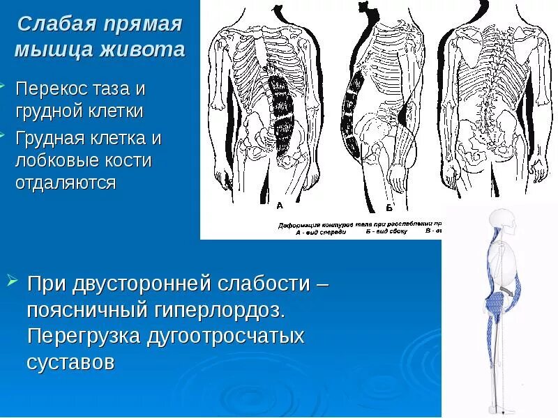 Нарушение мышц живота. Слабые прямые мышцы живота. укорочение прямой мышцы живота. слабые места прямой мышцы живота. слабые мышцы спины и живот.