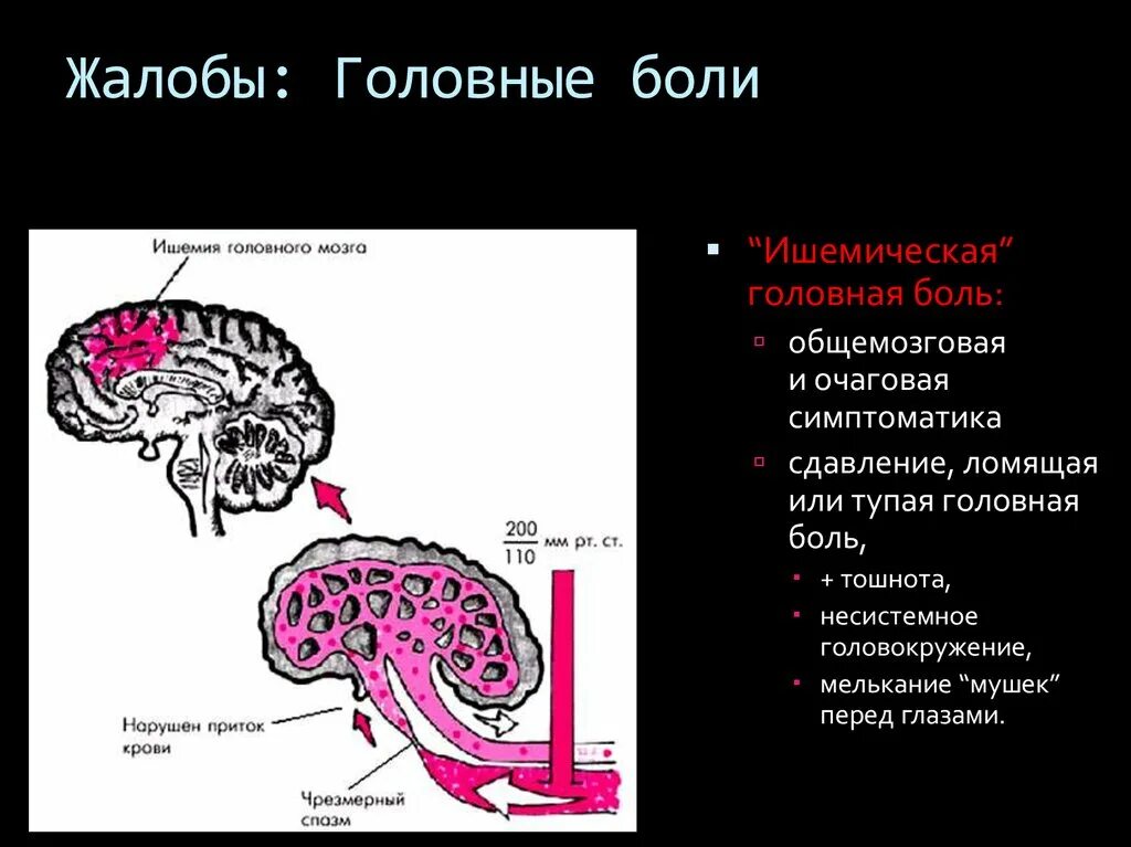 Ишемия мозга 2 ст. Хроническая ишемия головного мозга. Хроническая ишемия головного мозга жалобы. Ишемическая головная боль. Хроническая ишемия головного мозга стадии.