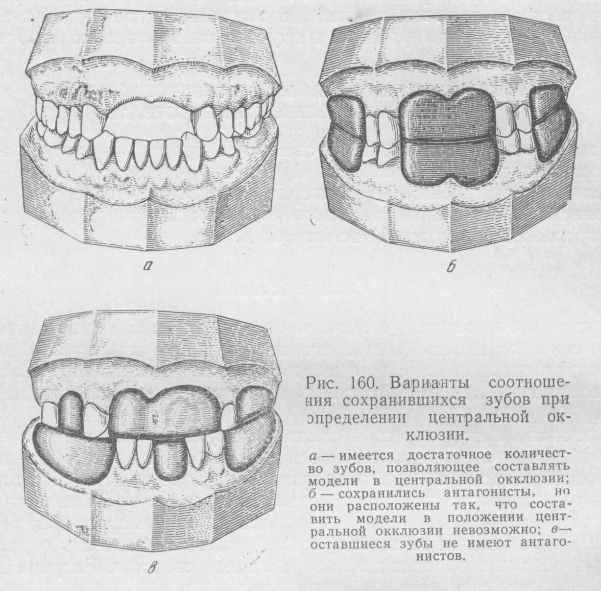 Линия базиса. Центральная окклюзия в стоматологии ортопедической. Соотношение зубных рядов в центральной окклюзии. Методы определения центральной окклюзии при дефектах зубных рядов.