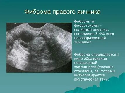 Солидное образование правого яичника