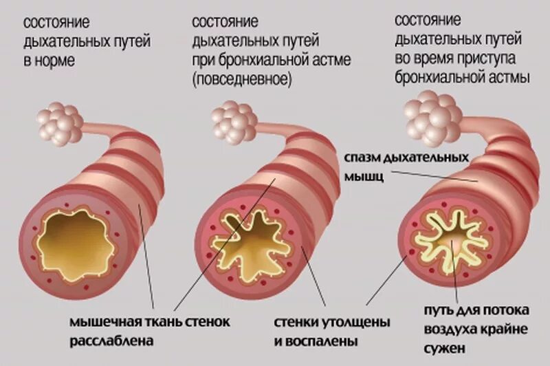 Скрытый бронхоспазм. Приступ бронхиальной астмы это бронхоспазм. приступ бронхиальной астмы это бронхообструктивный синдром. механизм обструкции бронхов при бронхиальной астме. аллергический бронхообструктивный синдром.