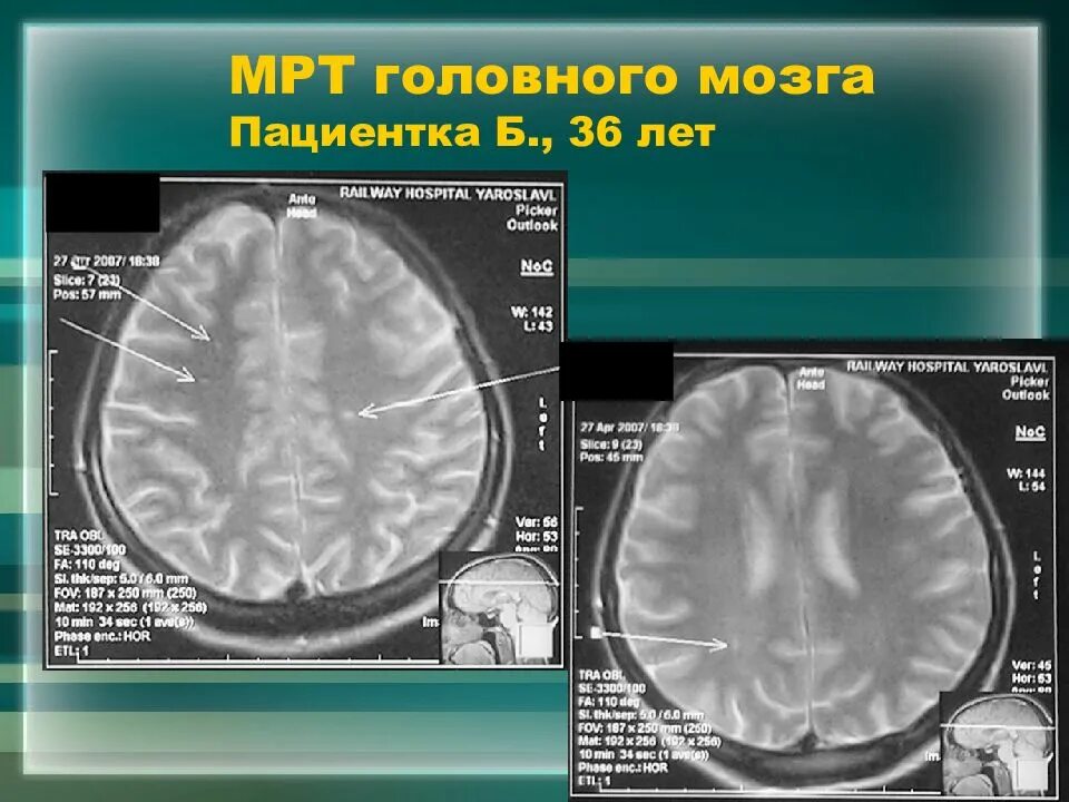 Склероз мозга. Рассеянный склероз на мрт головного мозга. Рассеянный склероз на мрт т1. Очаги рассеянного склероза. Очаги на мрт головного мозга при рассеянном склерозе.