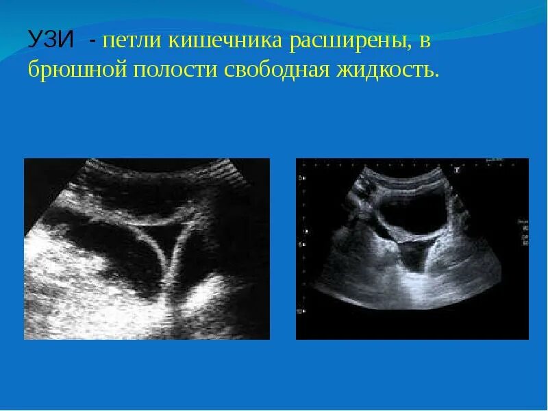 Расширение петель Толстого кишечника по УЗИ. Свободная жидкость в брюшной полости на УЗИ. Расширенные петли кишечника на УЗИ