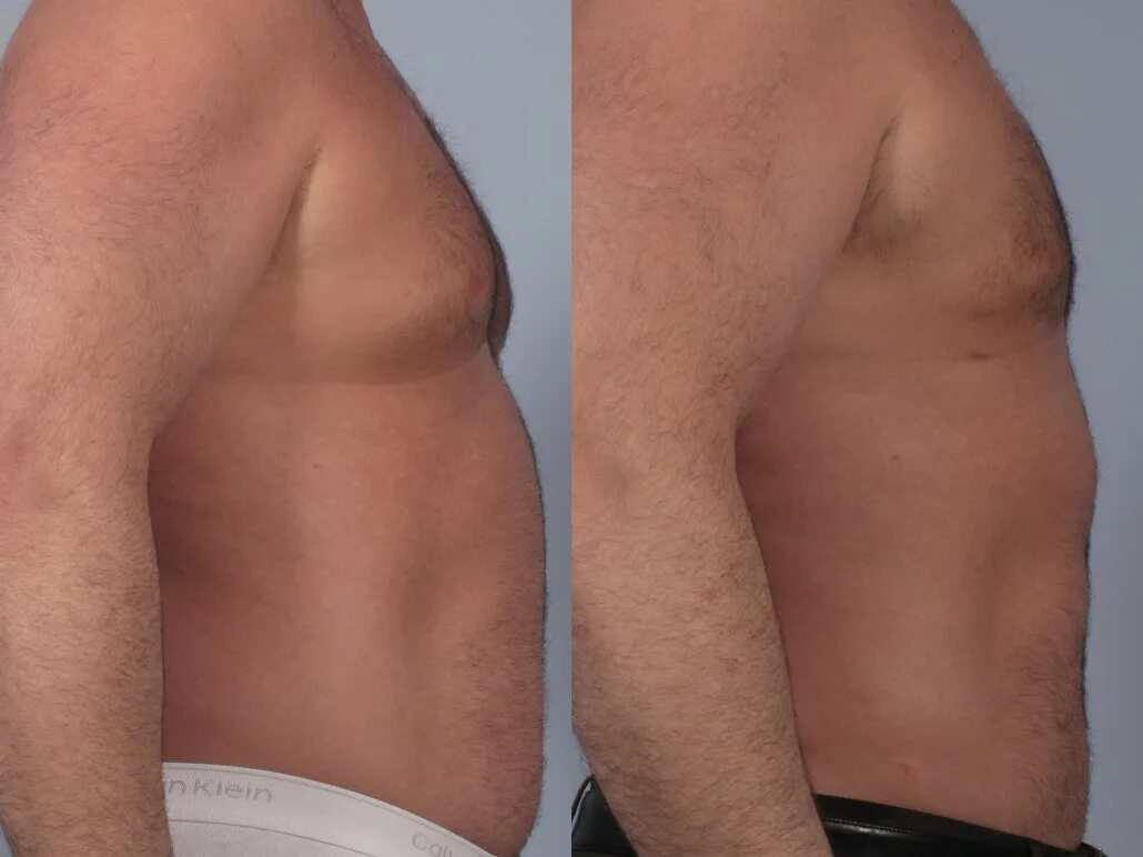 липосакция живота у мужчин. Vaser lipo. Vaser lipo. пресс на животе. липосакция для мужчин.