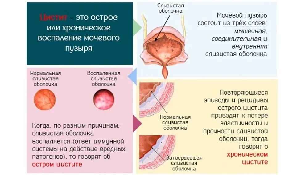 Цистит воспаление мочевого пузыря. Интерстициальный цистит. Хронический гранулярный цистит. Воспалительный процесс в мочевом пузыре. Воспалительный процесс в мочевом пузыре.