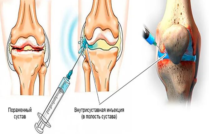Что колят в суставы. Внутрисуставные блокады коленного сустава. Внутрисуставные инъекции в коленный сустав. Блокада Дипроспан коленный сустав. Внутрисуставные инъекции для блокады.