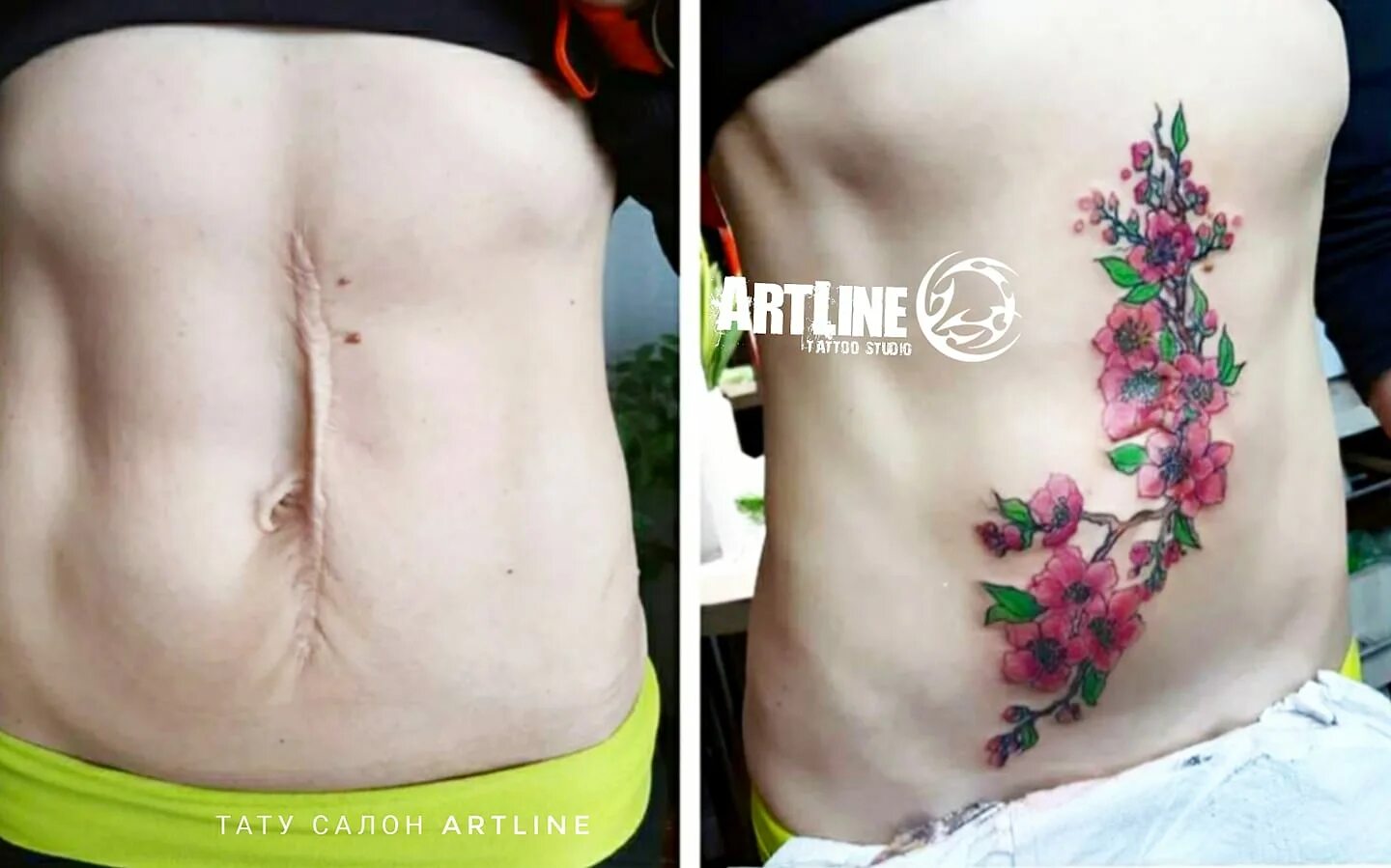 Келоидный рубец абдоминопластика. Можно ли бить тату на шрамах. Тату для перекрытия шрама на бедре. Тату перекрытие шра ов на ноге. Перекрытие шрамов татуировкой.
