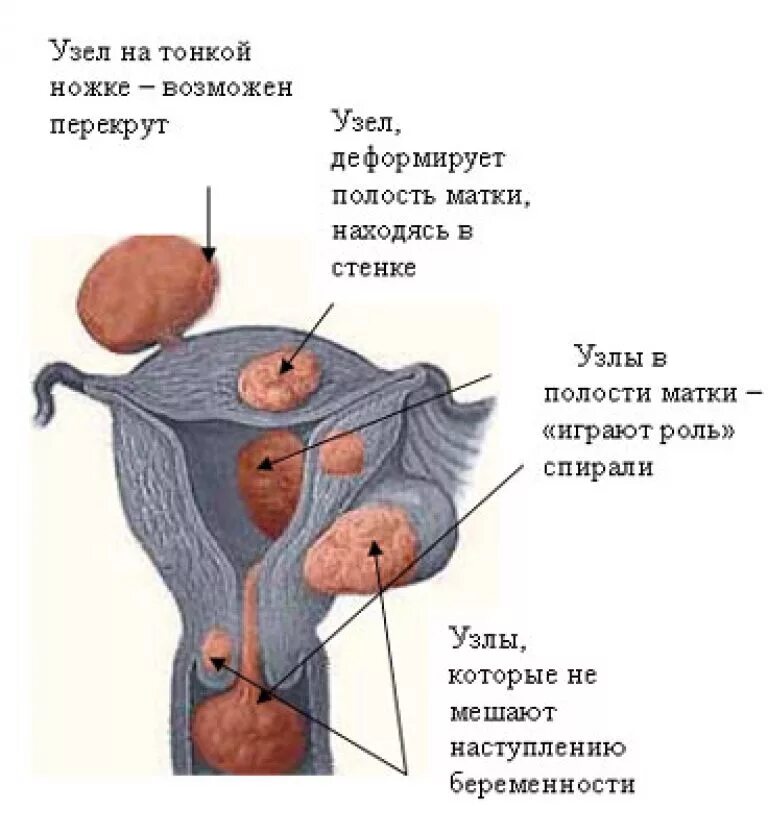 Миома по передней стенке матки. Миоматозный узел матки. миома на задней стенке матки.