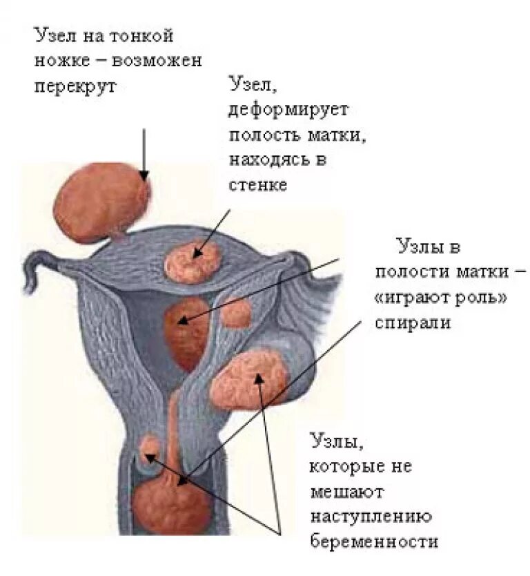 Миома на задней стенке матки