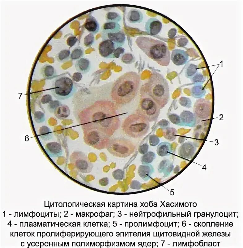 Цитологическое исследование пунктата. Тиреоидита Хашимото щитовидной железы. Тиреоидит Хашимото гистология. Клетки щитовидной железы цитология. Аутоиммунный тиреоидит Хашимото микропрепарат патанатомия.