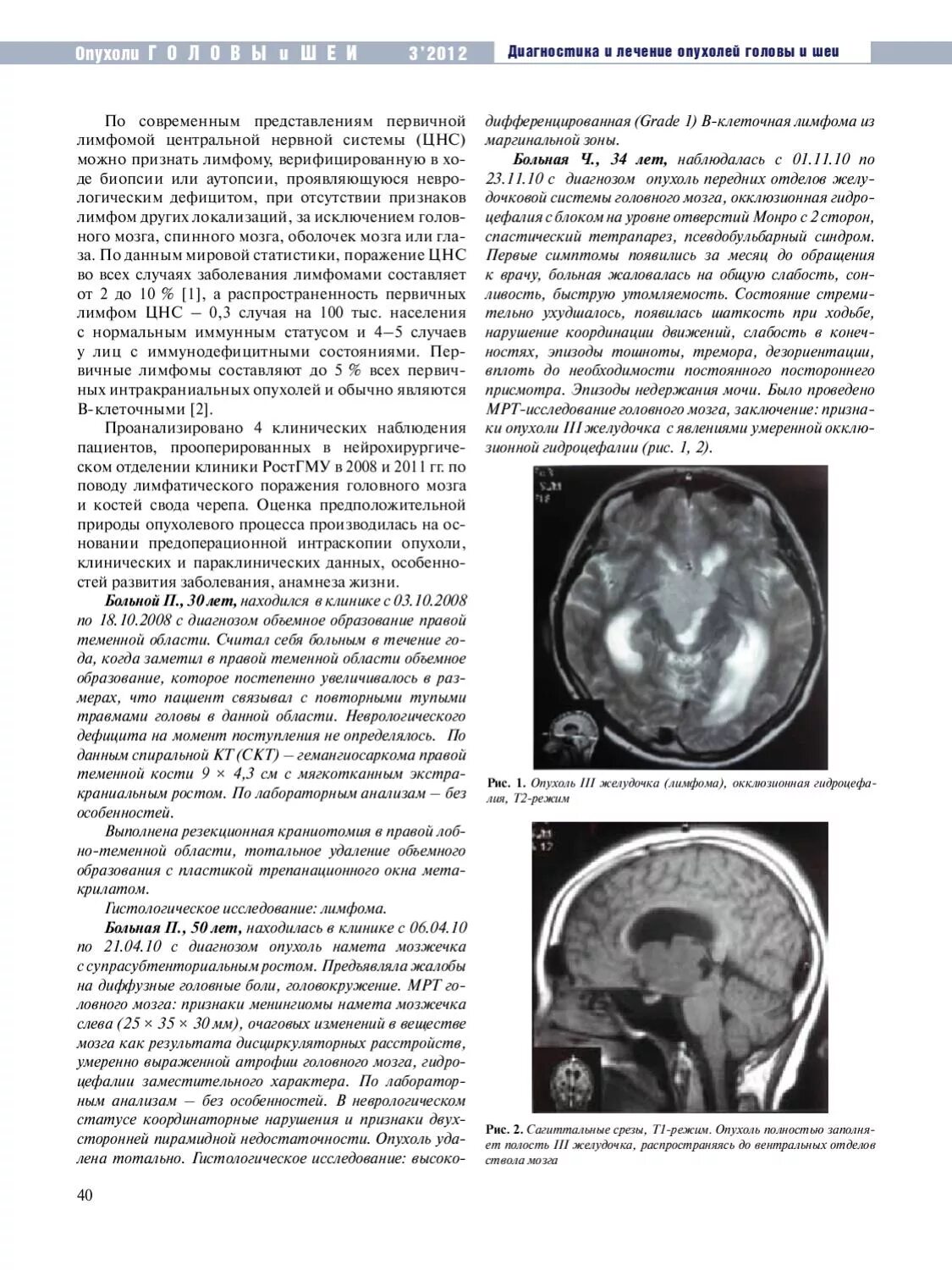 Очаговые изменения дисциркуляторного дистрофического характера. Краниофарингиома гипофиза кт. Дисциркуляторные очаги в веществе головного мозга. Профилактика опухолей головы и шеи.