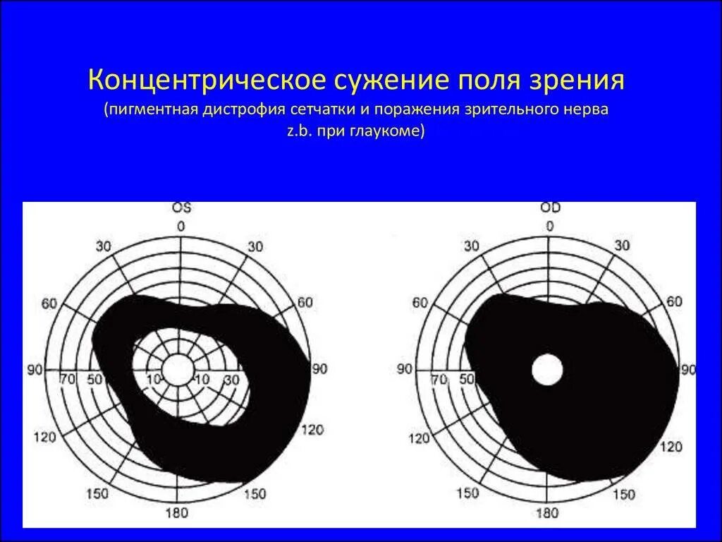 Какие точки зрения на причины и способы. Сужение периферического поля зрения. Поля зрения при дистрофии сетчатки. Концентрическое сужение полей зрения. Сужается поле зрения.