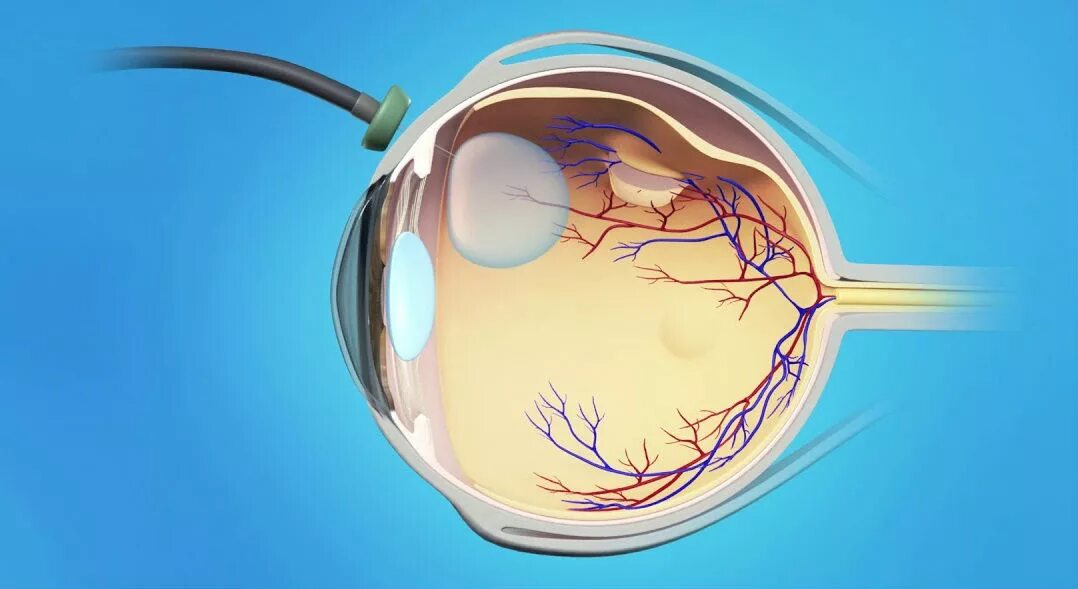 Отслойка сетчатки глаза. Отслойка сетчатки зрение. Лазерная фотокоагуляция сетчатки. Отслоение сетчатки хирургическая операция. Замена сетчатки