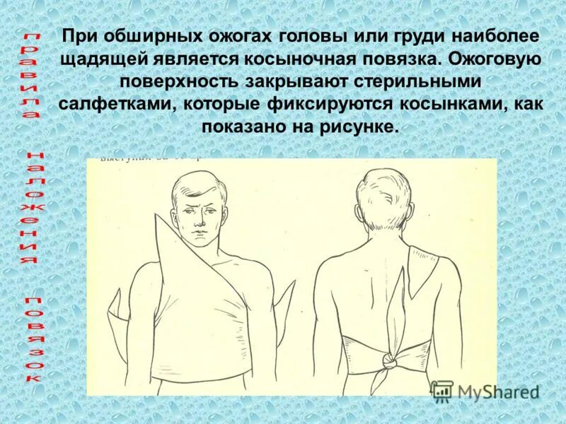 асептическая повязка при ожогах алгоритм. раневая повязка. асептическая повязка при ожогах. наложение повязки при ожоге.