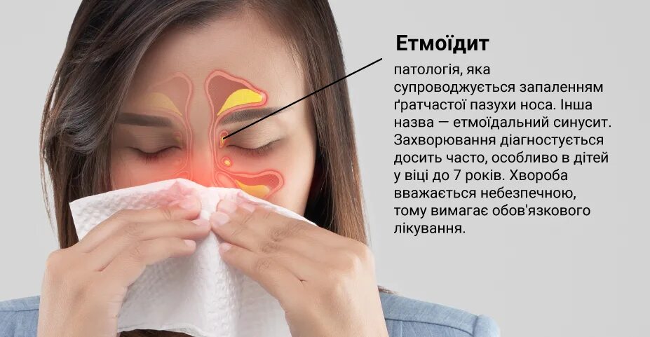 Этмоидит (воспаление решетчатой пазухи). Этмоидит симптомы и лечение у взрослых. Этмоидит симптомы и лечение у взрослых. Клиновидная пазуха и сфеноидит. Этмоидит (воспаление решетчатой пазухи).