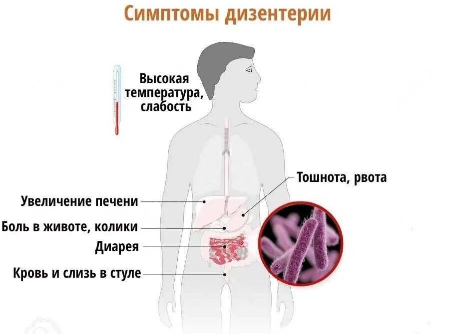 Шигеллы дизентерия симптомы. Основные клинические симптомы дизентерии. Бактериальная дизентерия шигеллез симптомы. Бактериальная дизентерия клинические проявления. Дизентерия вирусное заболевание