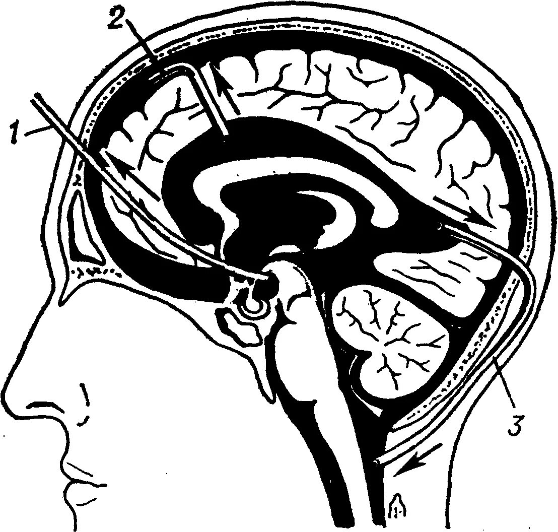 Подпаутинные цистерны головного мозга. Субарахноидальное пространство гидроцефалия. Цистерны подпаутинного пространства. Операция Торкильдсена вентрикулоцистерностомия. Изменение ликворокистозного характера