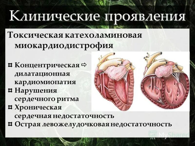 Кардиомиопатия патанатомия. Дилатационная кардиомиопатия это простыми словами. Дилатационная кардиомиопатия это простыми словами. Клинические проявления дилатационной кардиомиопатии. Кардиомиопатия дилатационная 142.