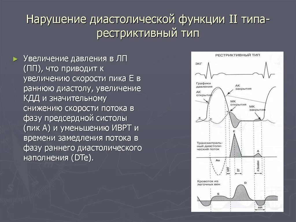 Дисфункции желудочков сердца. Типы нарушения диастолической функции лж. Диастолическая дисфункция левого желудочка эхокардиография. Эхо кг диастолическая дисфункция левого желудочка. Оценка диастолической функции левого желудочка по эхокардиографии.