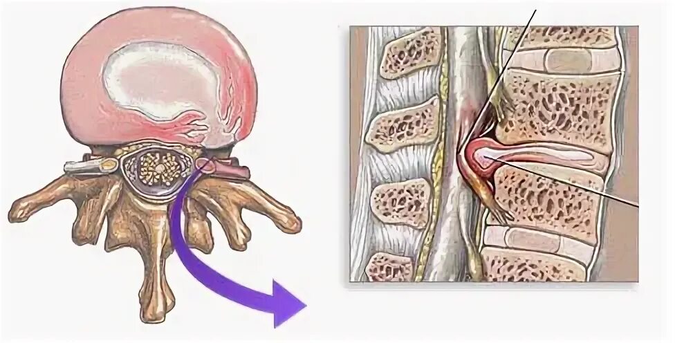 Нельзя делать для шейного отдела с грыжей. Один глаз больше прикрыт больше и грыжа шейного отдела. Шейная грыжа операция отзывы